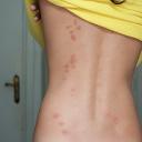 Bed bugs in buffalo new york
