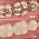 Teeth filling color Shorewood, IL