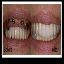 Dental Implants Stephenville, TX