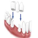 Dental Crowns in Glendale, AZâ€Ž