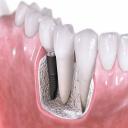 Dental Implants in Glendale, AZâ€Ž