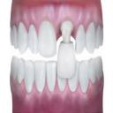 Porcelain Veneers in Carrollton, TX